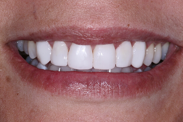 Tooth Reshaping Before - Step into the transformation journey with a candid "before" snapshot of tooth reshaping.