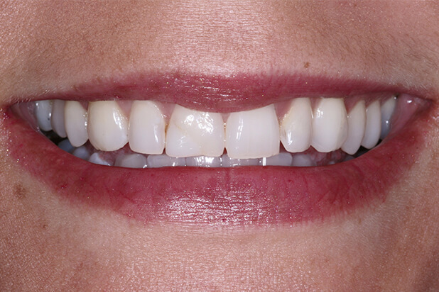 Tooth Reshaping After - Experience the stunning results of tooth reshaping in this radiant "after" photo.