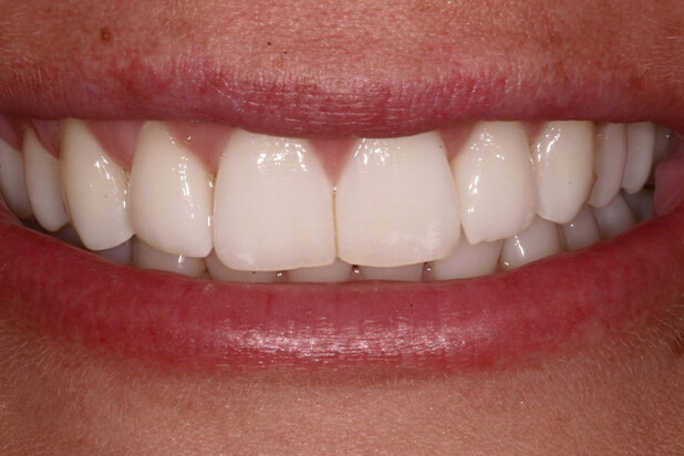 Veneers Before - Peek at a smile's journey with veneers, starting with a hopeful "before" snapshot.