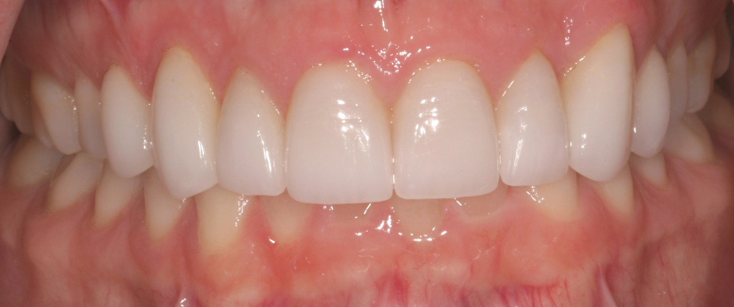 Lisa's Smile After Veneers