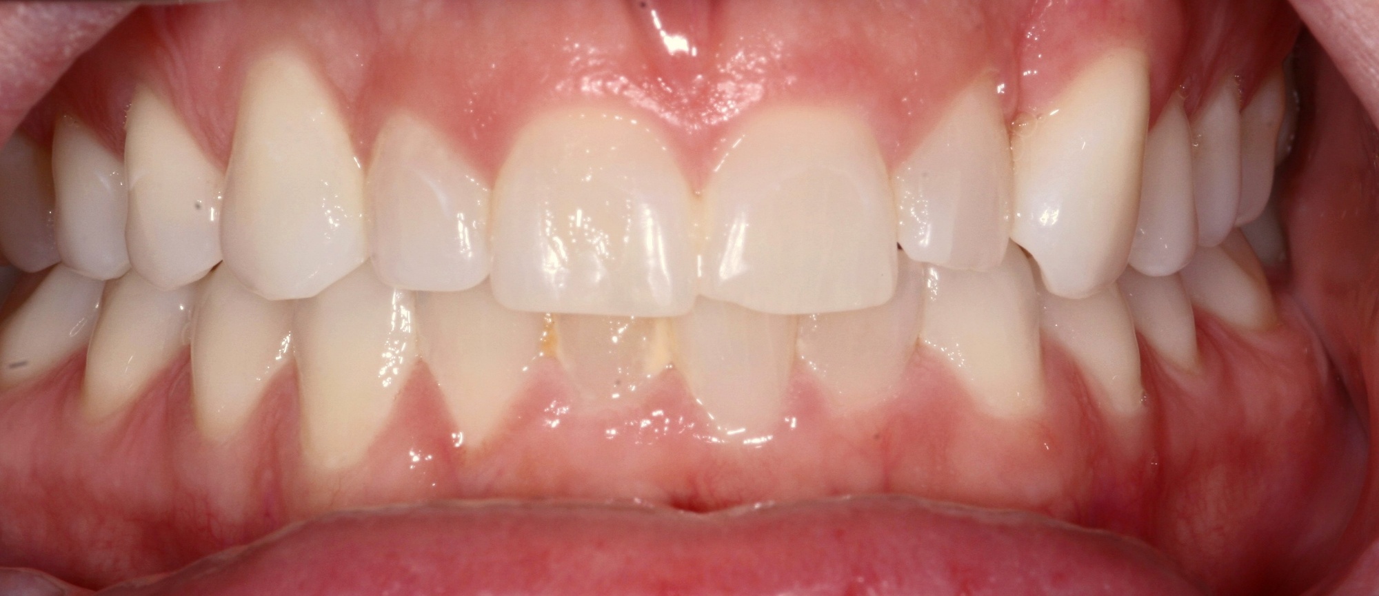 Lisa's Smile Before Veneers