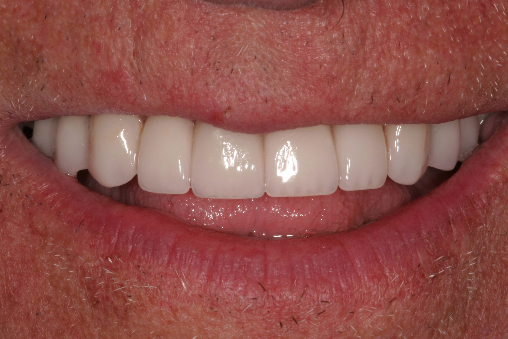 Verne's Smile After Cosmetic Dentistry Treatment