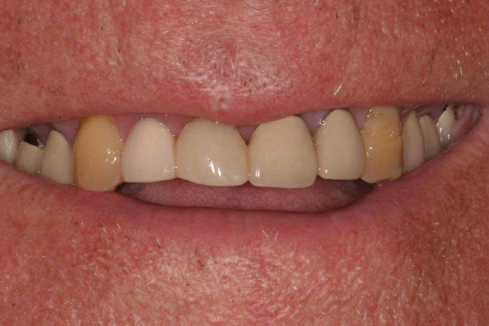 Verne's Smile Before Cosmetic Dental Treatment