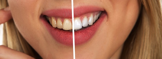 Before and After Teeth Whitening