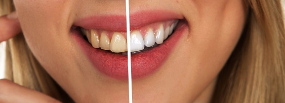 Before and After Teeth Whitening