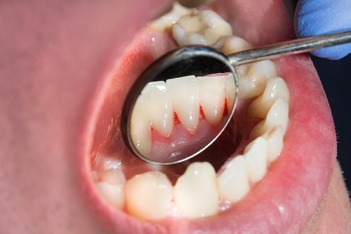 Bleeding Gums for Disease