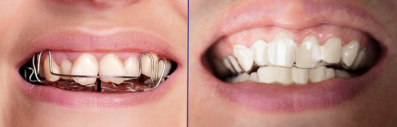 Braces and Retainers vs Invisalign