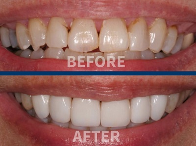 Before and After Cosmetic Dentistry