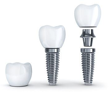 Dental Implants