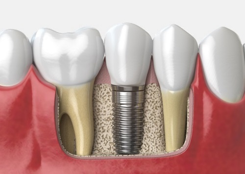 Dental implants replace missing teeth to restore your smile and gums Affordable Dental implants from Madison Dentists