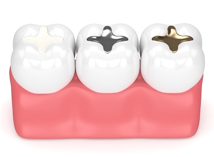 Cavity-Free for Life: The Benefits of Dental Fillings