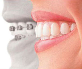 Invisalign Madison