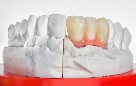 Dental Bridge for Lower Jaw