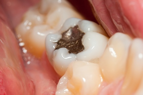 Silver fillings do not match the color of natural teeth Mercury Amalgam on White Tooth