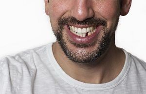 Bridges replace missing teeth