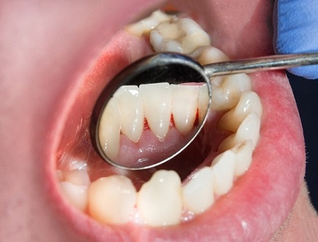 Oral Cancer in the Gums