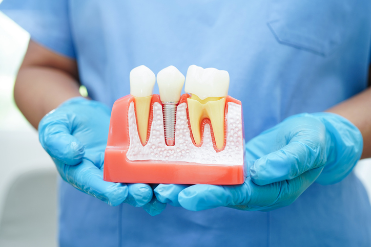 Dental implants in DeForest wi