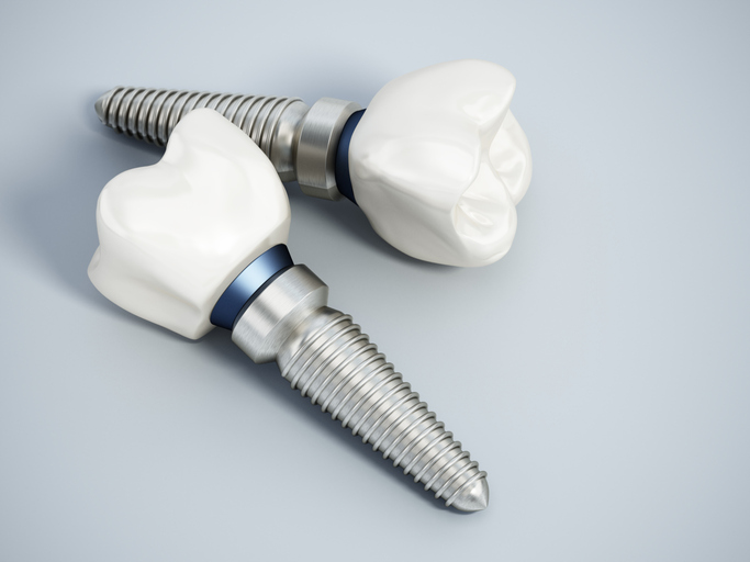dental implants in mcfarland wi