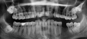 X-ray Showing Missing Teeth