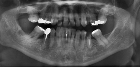 X-Ray Showing Dental Fillings