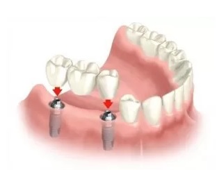 all on 4 implants procedure Madison