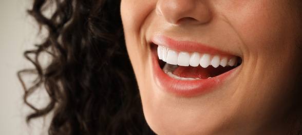 Bonded Veneers