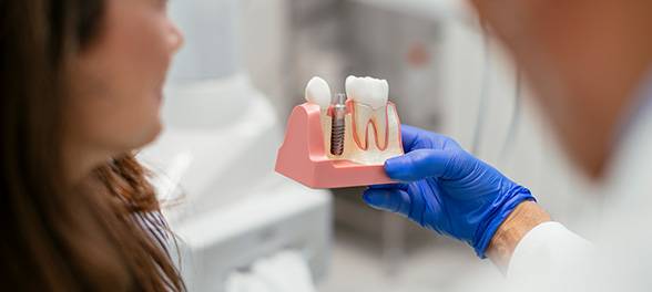 Dental Implants