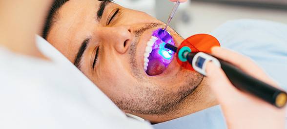 Resin Fillings
