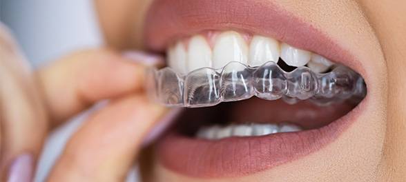 Invisalign