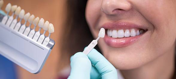 Porcelain Veneers