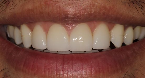 Veneers before & after 1