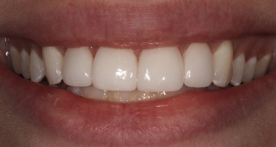 Veneers before & after 2