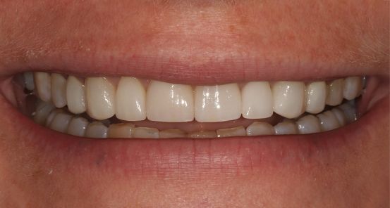 Veneers before & after 3