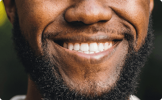 Invisalign before & after 3