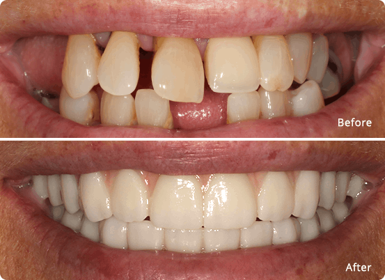 Full mouth restoration before & after 1