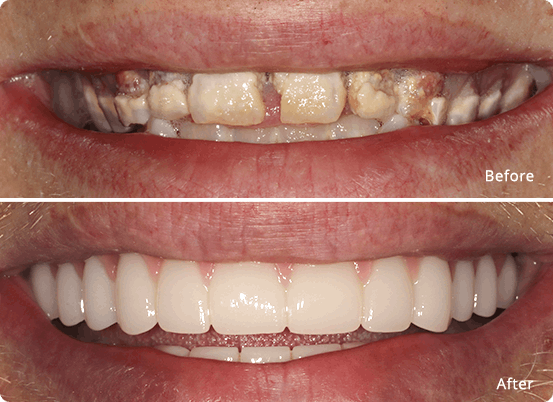 Full mouth restoration before & after 2