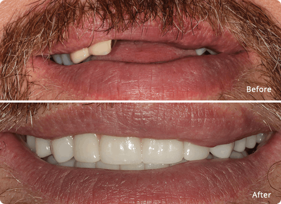 Full mouth restoration before & after 3